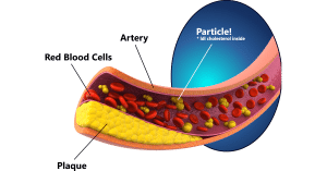 artery particle cholesterol plaque